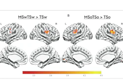 Brain fMRI activation maps showing statistical comparisons of temporal-spatial processing regions with color-coded intensity scales
