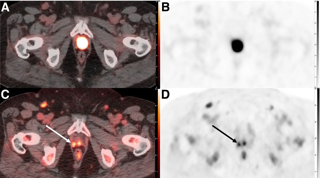 PET-CT scan composite showing axial cross-sections of pelvis with radioactive tracer uptake and anatomical structures