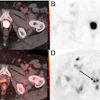 PET-CT scan composite showing axial cross-sections of pelvis with radioactive tracer uptake and anatomical structures