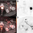 PET-CT scan composite showing axial cross-sections of pelvis with radioactive tracer uptake and anatomical structures