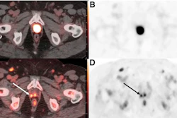 PET-CT scan composite showing axial cross-sections of pelvis with radioactive tracer uptake and anatomical structures