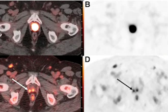 PET-CT scan composite showing axial cross-sections of pelvis with radioactive tracer uptake and anatomical structures