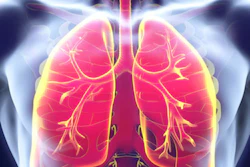 Anatomical illustration of human lungs with bronchial branches and pulmonary blood vessels highlighted in pink and yellow