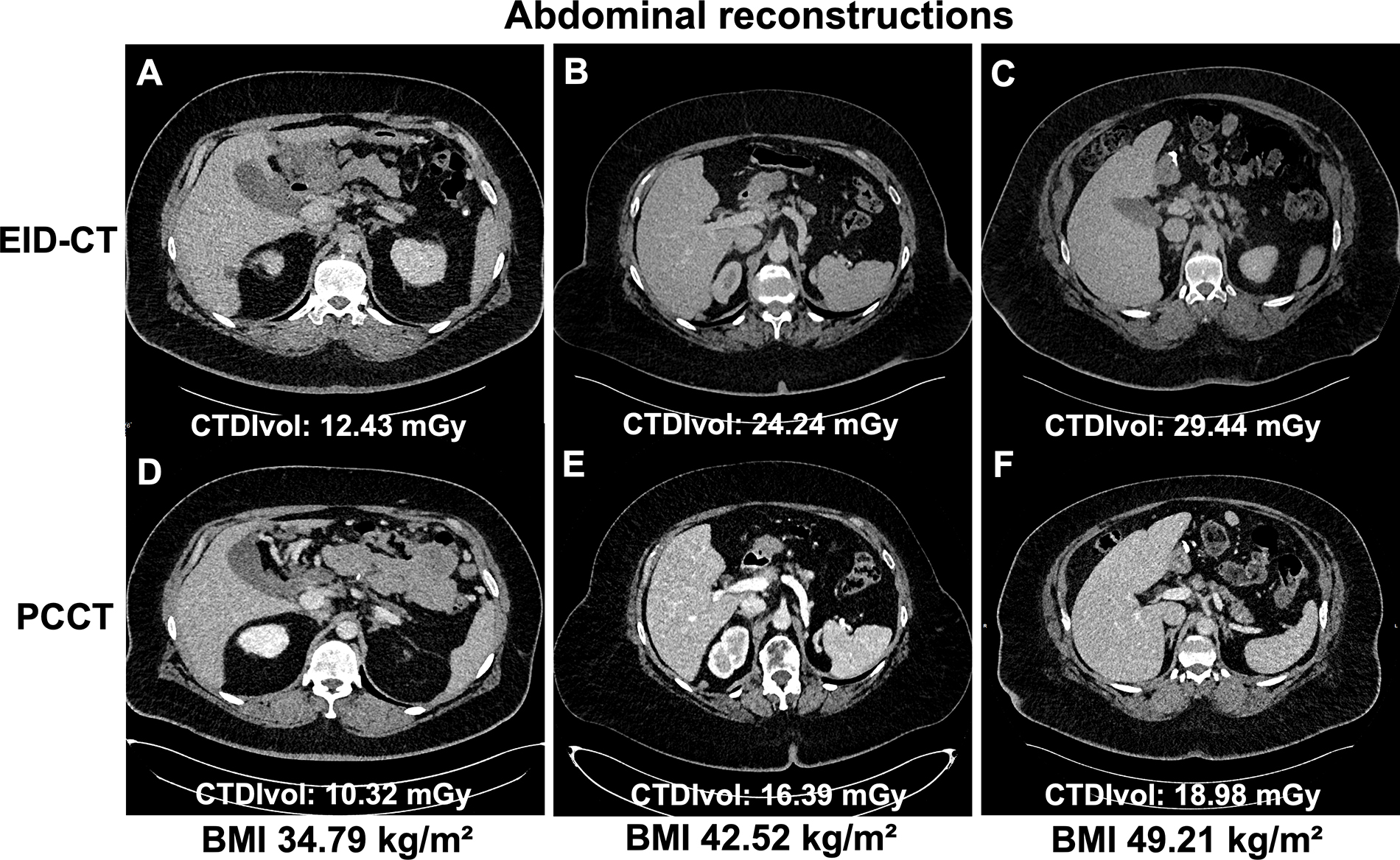 Comparative abdominal CT scans showing six cross-sectional images with varying BMI and radiation dose measurements