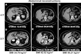 Comparative abdominal CT scans showing six cross-sectional images with varying BMI and radiation dose measurements
