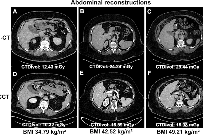 Comparative abdominal CT scans showing six cross-sectional images with varying BMI and radiation dose measurements