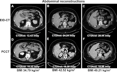 Comparative abdominal CT scans showing six cross-sectional images with varying BMI and radiation dose measurements
