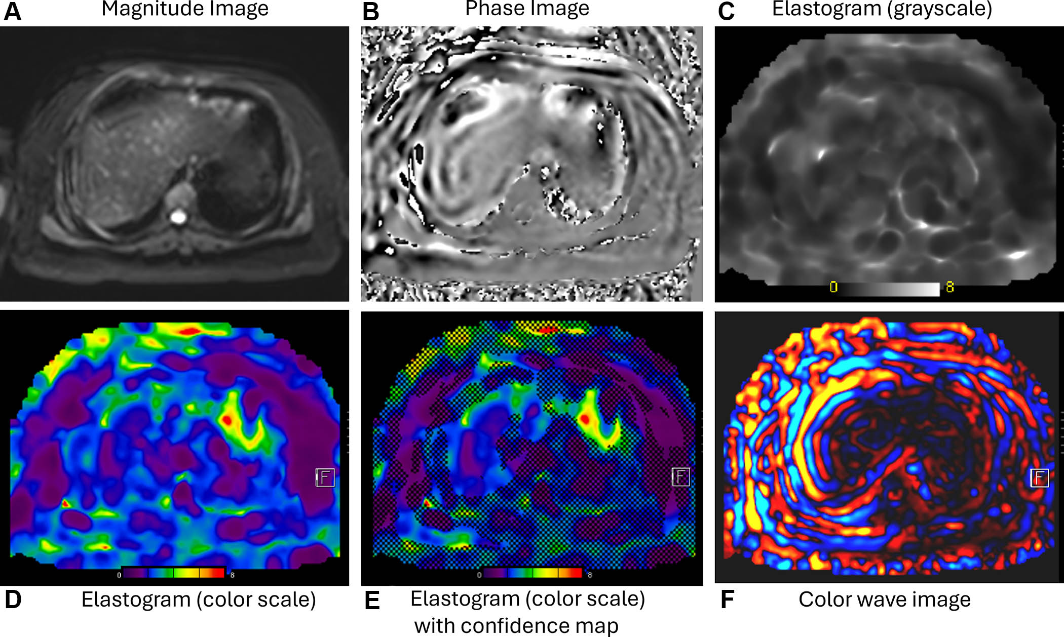 MRI elastography imaging panel showing magnitude, phase, and elastogram data with heat map visualizations for tissue stiffness analysis