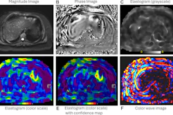 MRI elastography imaging panel showing magnitude, phase, and elastogram data with heat map visualizations for tissue stiffness analysis