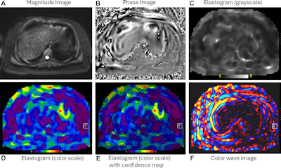 MR elastography standards reliable for imaging chronic liver disease