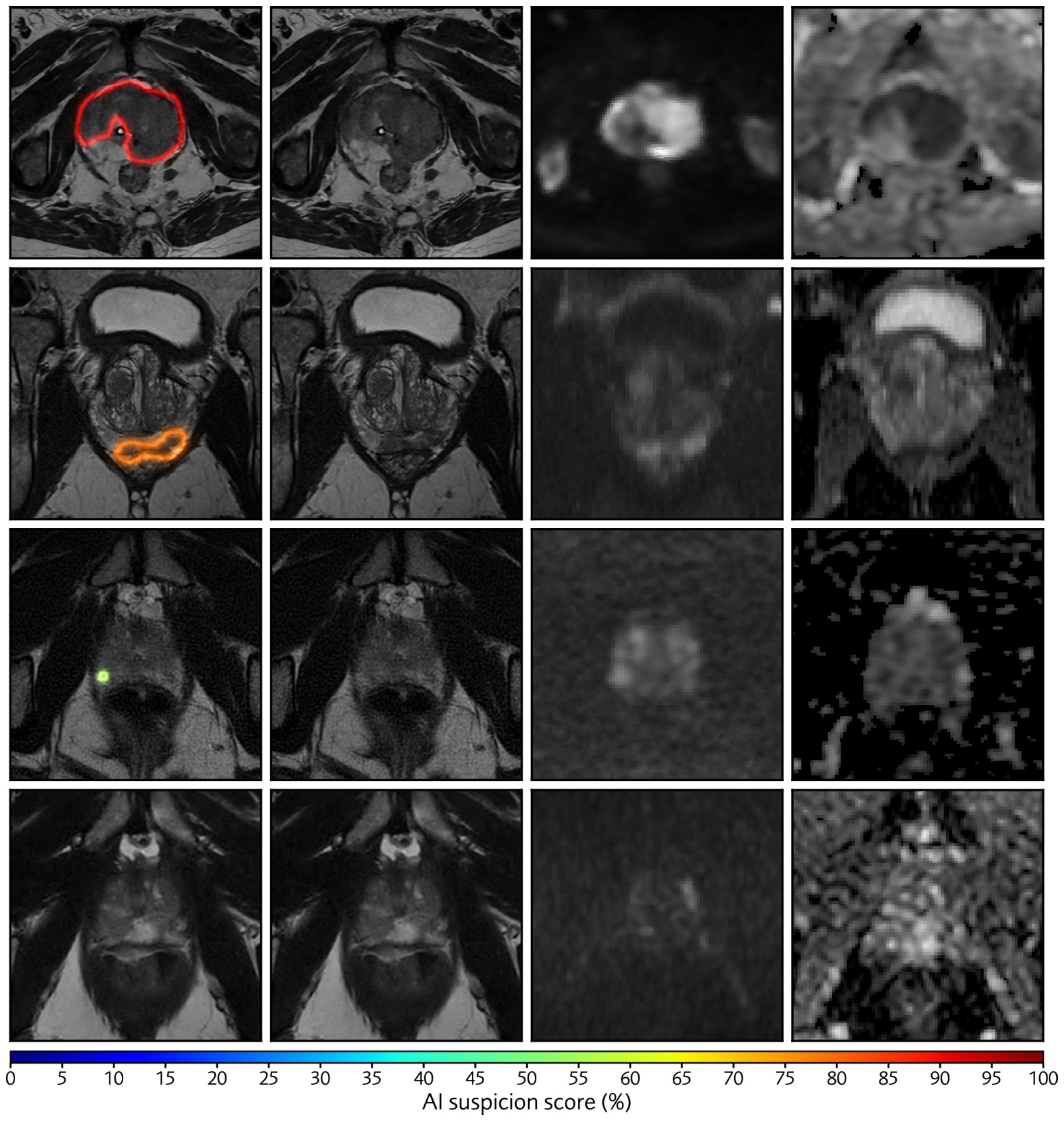 MRI brain scan grid showing axial slices with AI diagnostic analysis and suspicion score heatmap ranging from 0-100%
