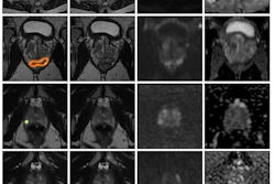 MRI brain scan grid showing axial slices with AI diagnostic analysis and suspicion score heatmap ranging from 0-100%