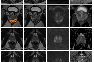 MRI brain scan grid showing axial slices with AI diagnostic analysis and suspicion score heatmap ranging from 0-100%