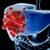 3D medical illustration of liver with red cancer cells showing hepatic tumor growth and disease progression