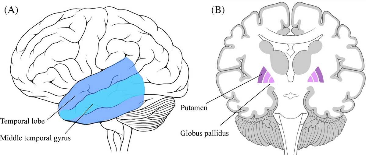 Brain anatomy diagram showing temporal lobe, middle temporal gyrus, putamen, and globus pallidus with labeled cross-sections.