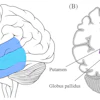 Brain anatomy diagram showing temporal lobe, middle temporal gyrus, putamen, and globus pallidus with labeled cross-sections.