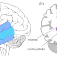 Brain anatomy diagram showing temporal lobe, middle temporal gyrus, putamen, and globus pallidus with labeled cross-sections.