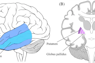 Brain anatomy diagram showing temporal lobe, middle temporal gyrus, putamen, and globus pallidus with labeled cross-sections.