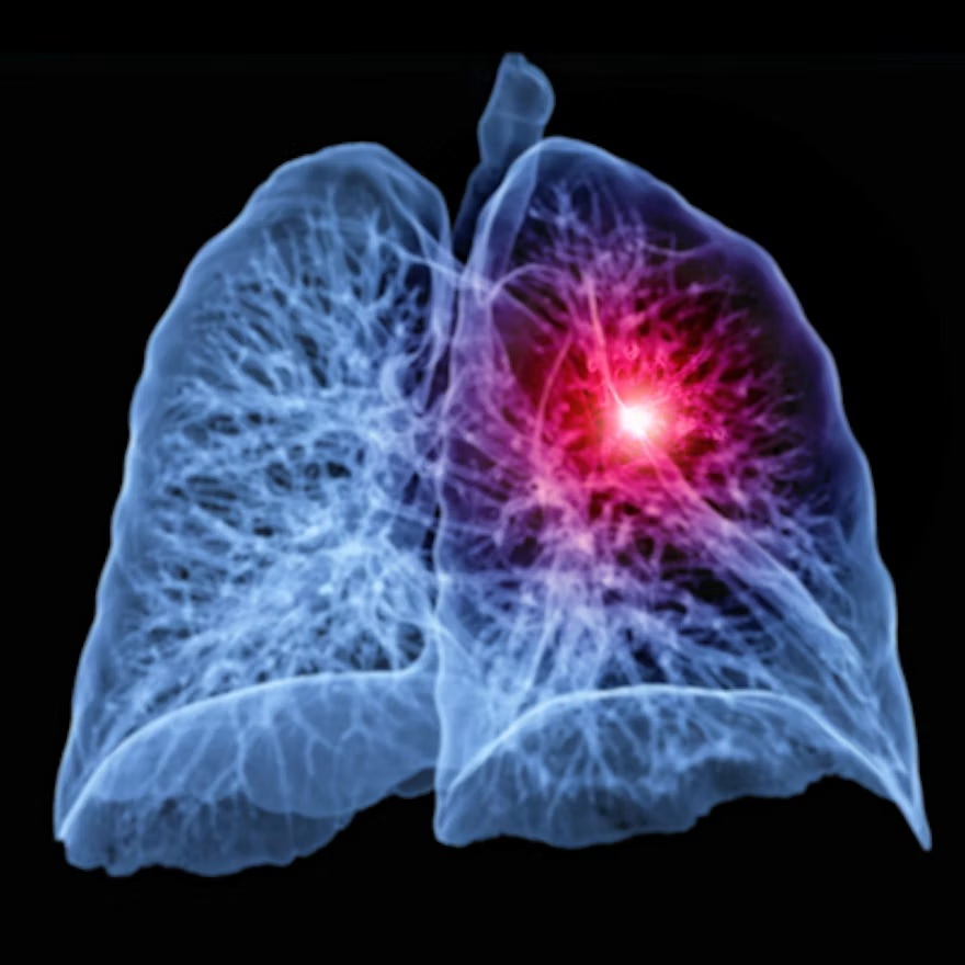 X-ray visualization of human lungs with red highlighted inflammation or abnormality in right lung