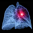 X-ray visualization of human lungs with red highlighted inflammation or abnormality in right lung
