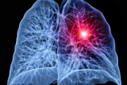 X-ray visualization of human lungs with red highlighted inflammation or abnormality in right lung