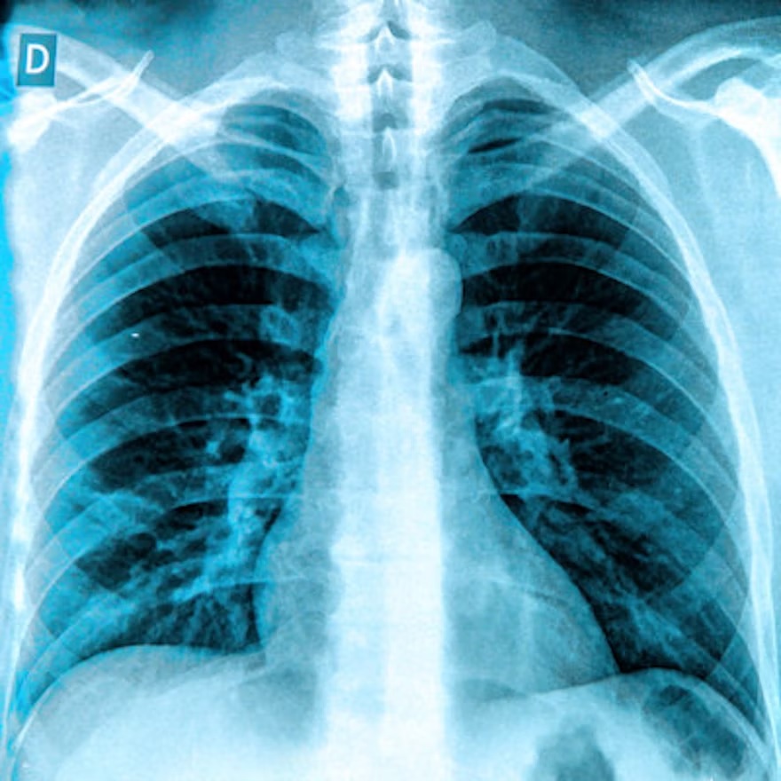Frontal chest X-ray showing bilateral lungs, ribcage, and thoracic spine with normal anatomical structures