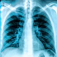 Frontal chest X-ray showing bilateral lungs, ribcage, and thoracic spine with normal anatomical structures