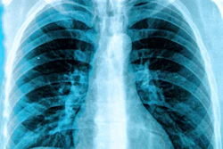 Frontal chest X-ray showing bilateral lungs, ribcage, and thoracic spine with normal anatomical structures