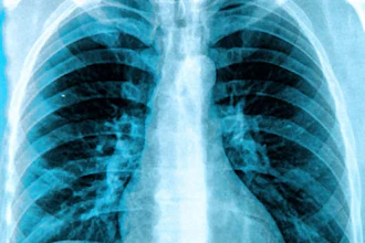Frontal chest X-ray showing bilateral lungs, ribcage, and thoracic spine with normal anatomical structures
