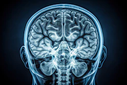 Coronal MRI scan of human brain showing cerebral hemispheres and brainstem structures in blue-toned medical imaging