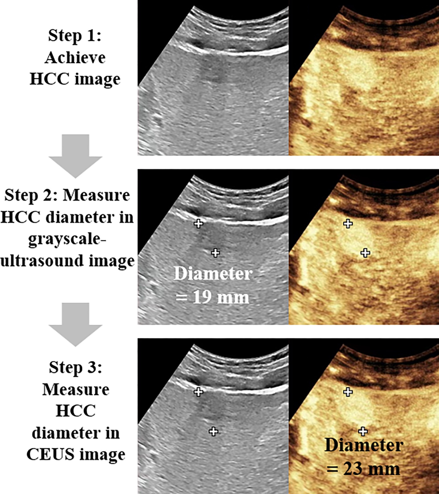 Three-step ultrasound procedure for measuring hepatocellular carcinoma diameter, showing grayscale and contrast-enhanced imaging with measurements of 19mm and 23mm.