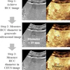 Three-step ultrasound procedure for measuring hepatocellular carcinoma diameter, showing grayscale and contrast-enhanced imaging with measurements of 19mm and 23mm.