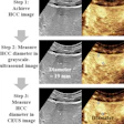 Three-step ultrasound procedure for measuring hepatocellular carcinoma diameter, showing grayscale and contrast-enhanced imaging with measurements of 19mm and 23mm.