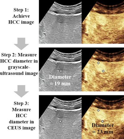 Three-step ultrasound procedure for measuring hepatocellular carcinoma diameter, showing grayscale and contrast-enhanced imaging with measurements of 19mm and 23mm.