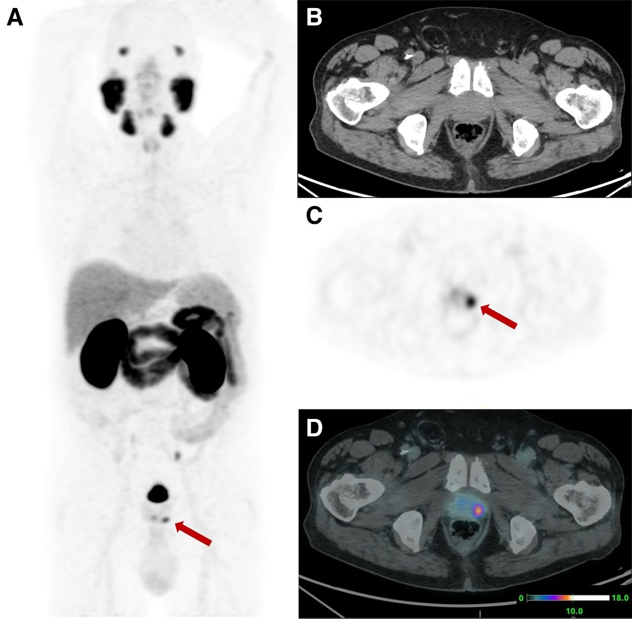 PET-CT scan images showing axial and coronal views of abdomen with arrows indicating focal lesions in kidney and lower abdomen regions