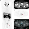 PET-CT scan images showing axial and coronal views of abdomen with arrows indicating focal lesions in kidney and lower abdomen regions
