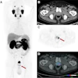 PET-CT scan images showing axial and coronal views of abdomen with arrows indicating focal lesions in kidney and lower abdomen regions
