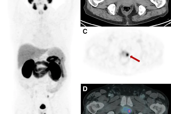 PET-CT scan images showing axial and coronal views of abdomen with arrows indicating focal lesions in kidney and lower abdomen regions