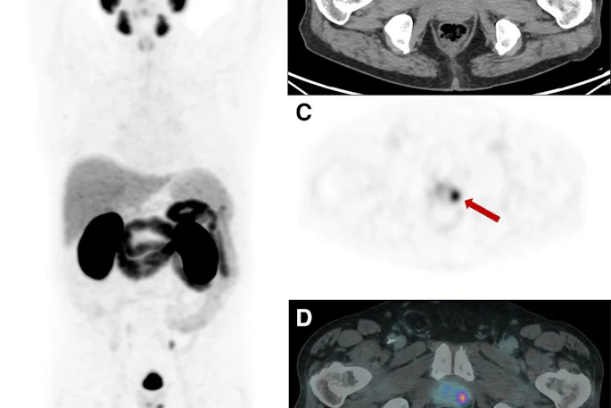 PET-CT scan images showing axial and coronal views of abdomen with arrows indicating focal lesions in kidney and lower abdomen regions