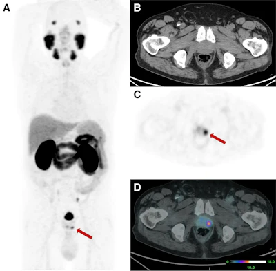 PET-CT scan images showing axial and coronal views of abdomen with arrows indicating focal lesions in kidney and lower abdomen regions