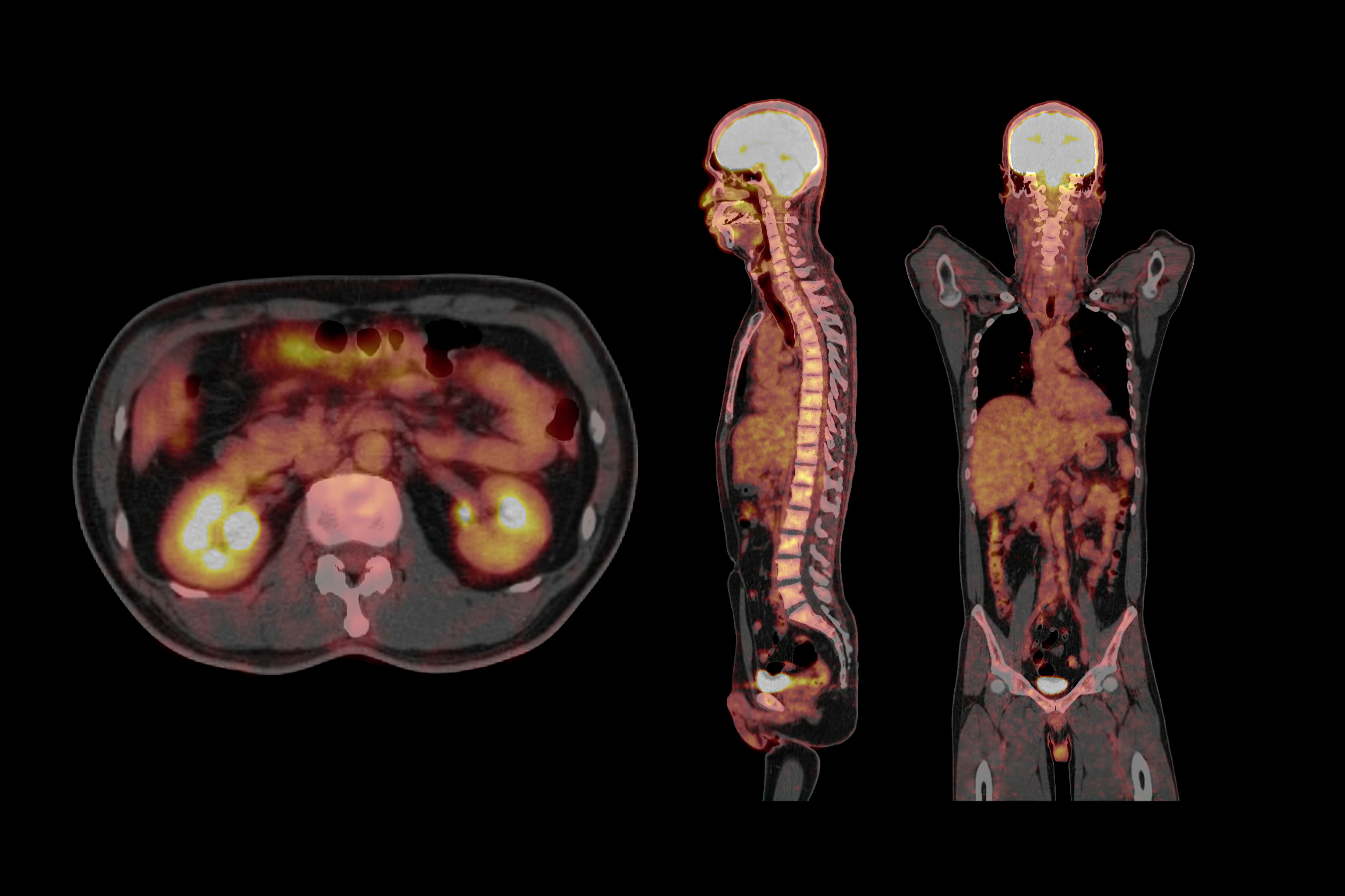 PET/CT scan showing axial, sagittal, and coronal views with metabolic activity visualization in yellow and orange