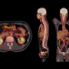 PET/CT scan showing axial, sagittal, and coronal views with metabolic activity visualization in yellow and orange