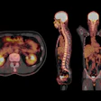 PET/CT scan showing axial, sagittal, and coronal views with metabolic activity visualization in yellow and orange