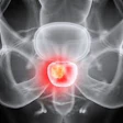 X-ray scan of pelvis with prostate gland highlighted in red, medical diagnostic imaging