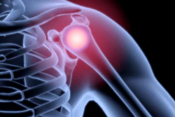 3D medical illustration of shoulder joint pain with glowing red inflammation on skeletal anatomy
