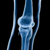X-ray image of human knee joint showing femur, tibia, fibula, and patella in anteroposterior view